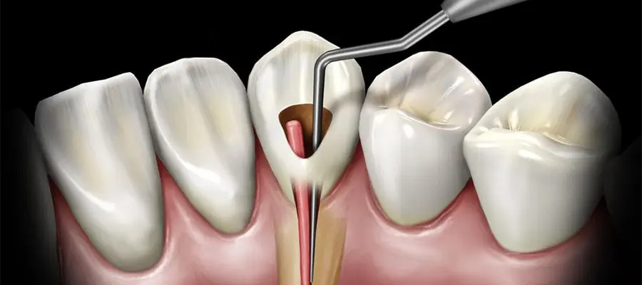 root-canal-treatment-in-turkey