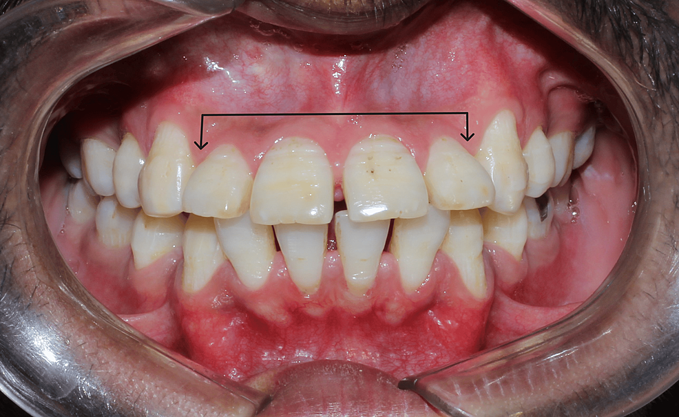 bone-grafting-turkey