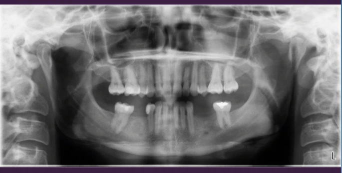 crown-bridge-prosthesis-in-turkey