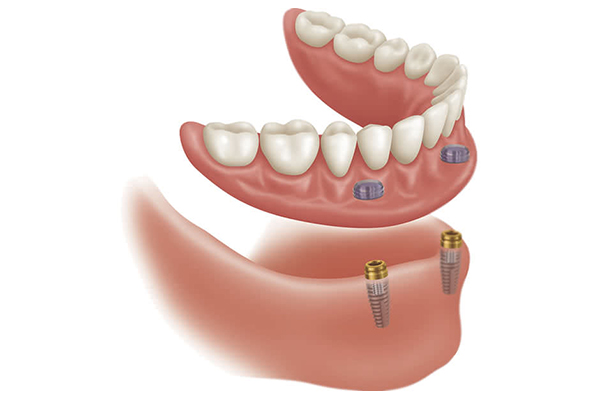 implant-supported-prosthesis