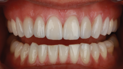 porcelain-veneer